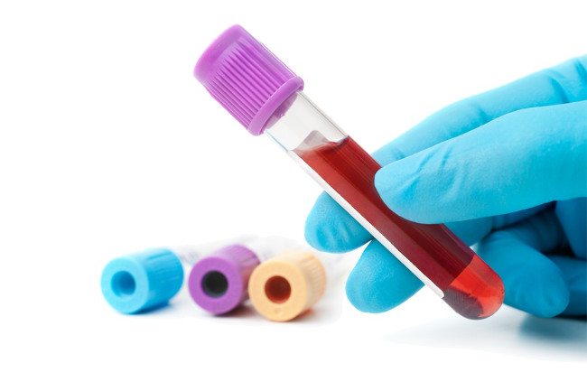 Nuevo análisis de sangre Figura 1 ayuda a detectar 8 tipos de cáncer de manera temprana