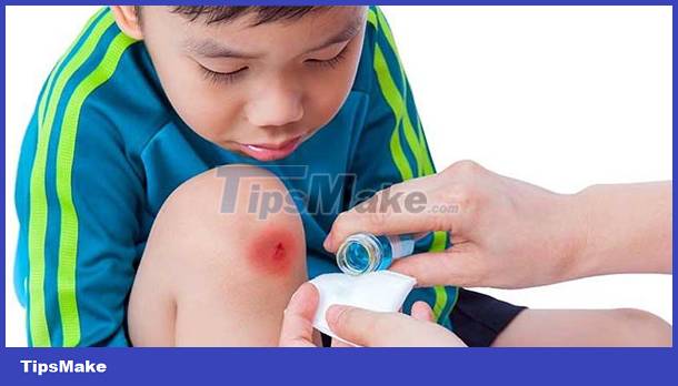 Cómo dar primeros auxilios a algunos accidentes comunes en los niños Imagen 4